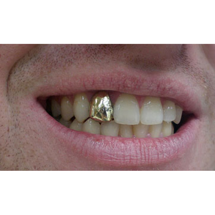 Грилзы на зубы (фиксы): зачем нужны золотые и серебряные накладки-вставки, как у реперов?