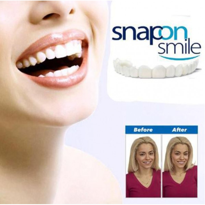 Decorative thin mouthguard, veeneers, onlays for the upper and lower jaw to correct smile, teeth tone Snap On Smile